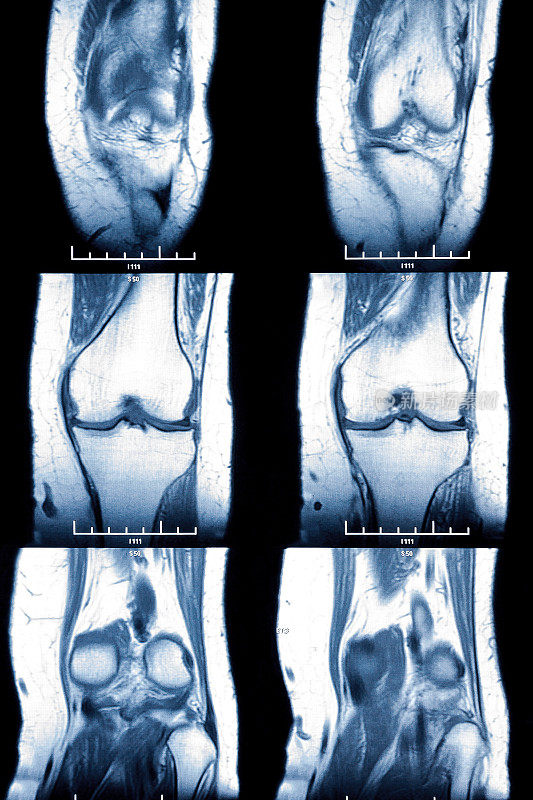 膝关节MR -交叉和半月板损伤